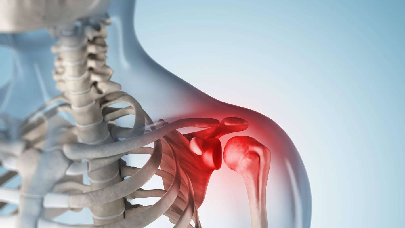 Omuz Sıkışma Sendromu (Impingement) ve Ortopedik Rehabilitasyonun Gücü